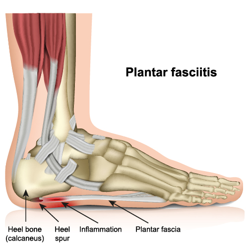 Heel Spur Removal - Foot - Surgery - What We Treat - Physio.co.uk